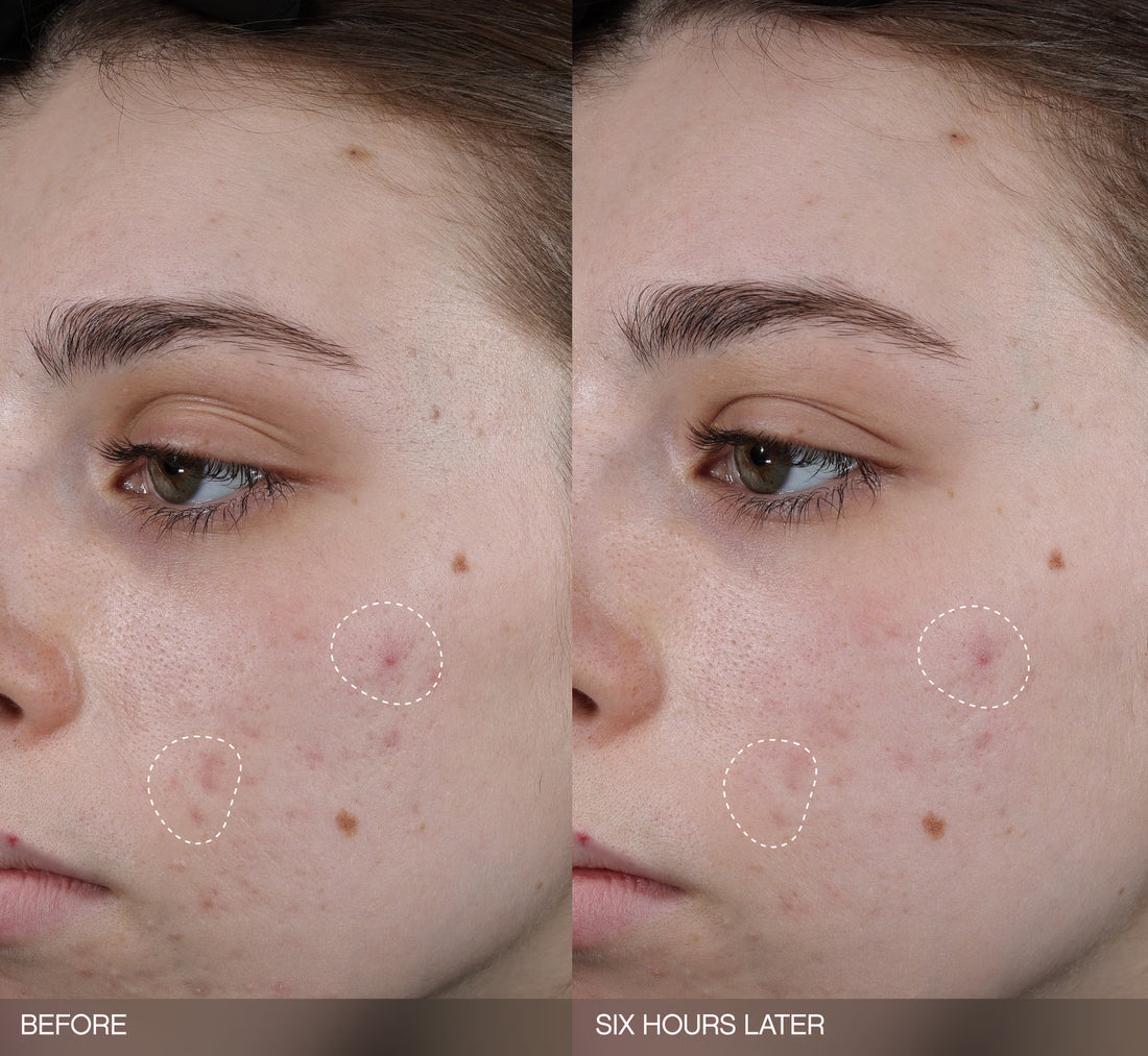 Faded Dark Spot Patches Topicals