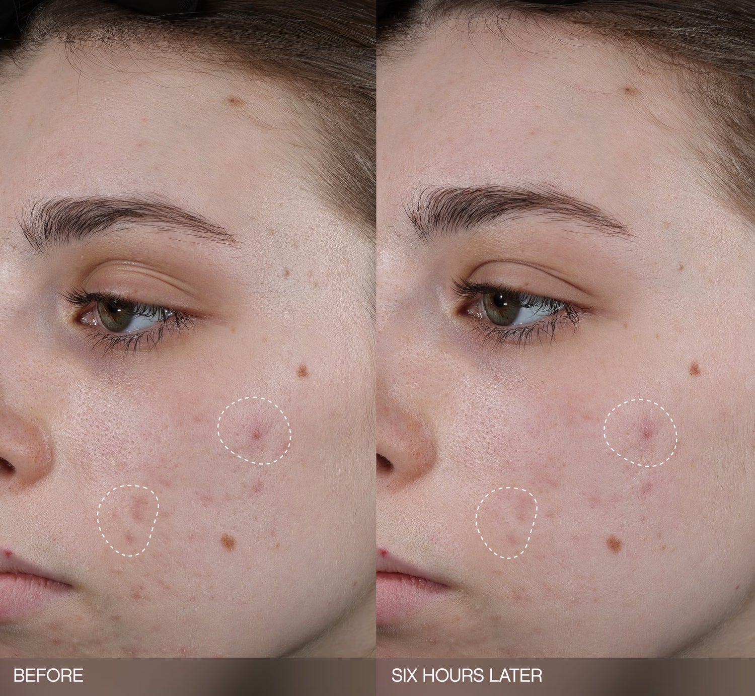 Faded Dark Spot Patches Topicals